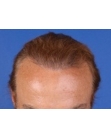 After Hair Transplant&nbsp;2 Sessions (Areas)